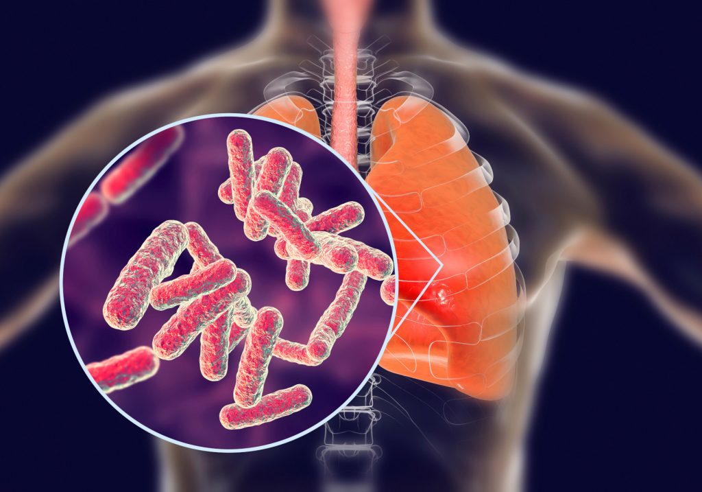 Tubercolosis