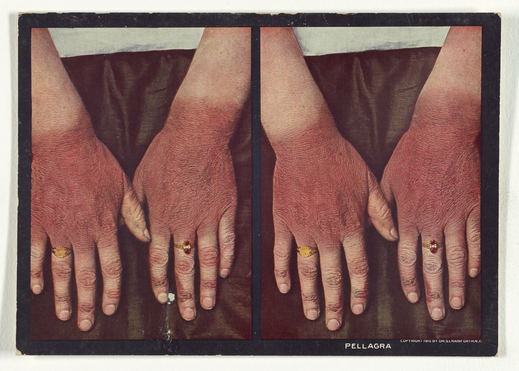 Outbreak Of Pellagra Hits 4,000 In Mozambique As UN Agency Shops For $91m To Rehabilitate Cyclone Victims Pellagra