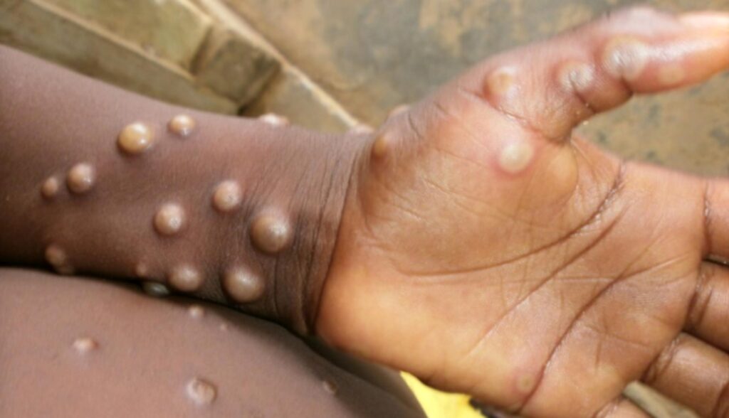 Monkeypox ravages Nigeria - Straightnews