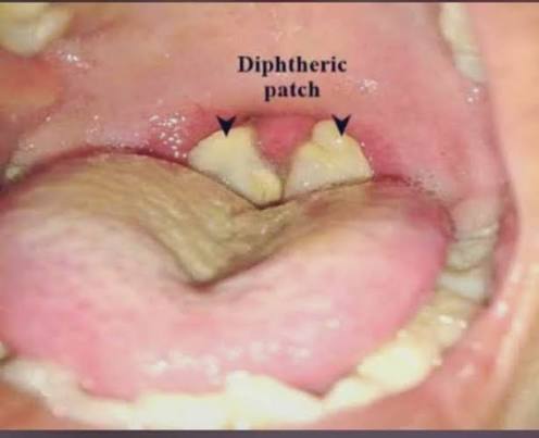 Diphtheria Outbreak Kills 27 in Plateau as cases surge Diphtheria outbreak kills 27 in Plateau - Straightnews